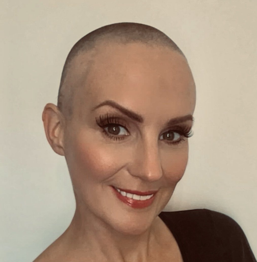 HEADS Brand Ambassador with alopecia, confident without a wig